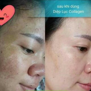 Combo 5 Diệp lục collagen