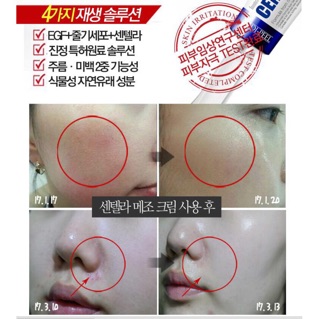 Kem đặc trị MỤN Centella Hàn Quốc 30ml