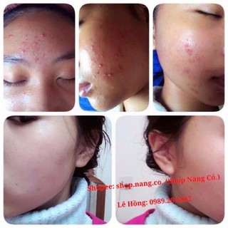 [Chính Hãng] Kem Đông Y KEM MỤN, KHỬ SẠCH MỤN, THÂM, DA DẦU, LỖ CHÂN LÔNG TO.. Diệt mụn ẩn, mụn bọc, mụn mủ, mụn đầu đen