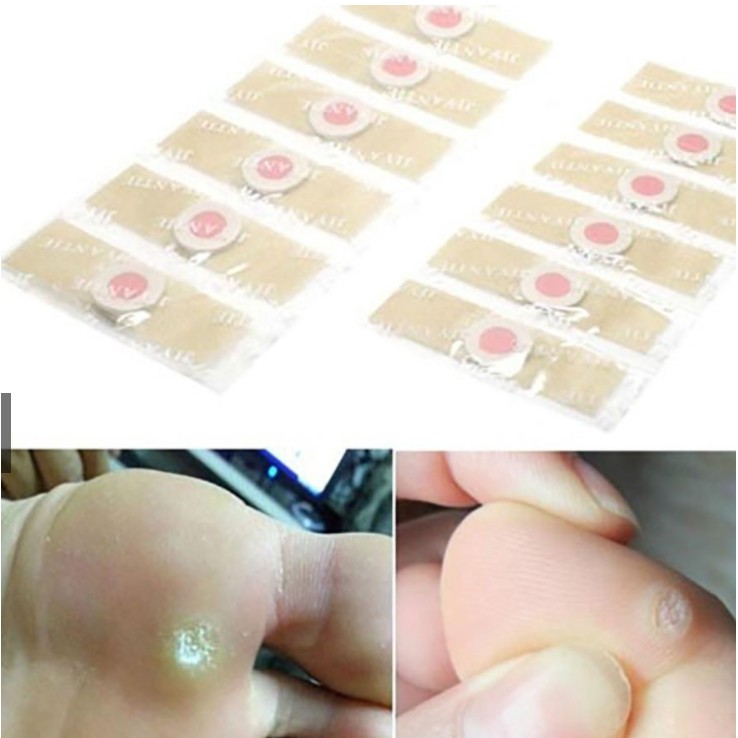 Hộp 6 miếng dán mụn cóc tay, chân