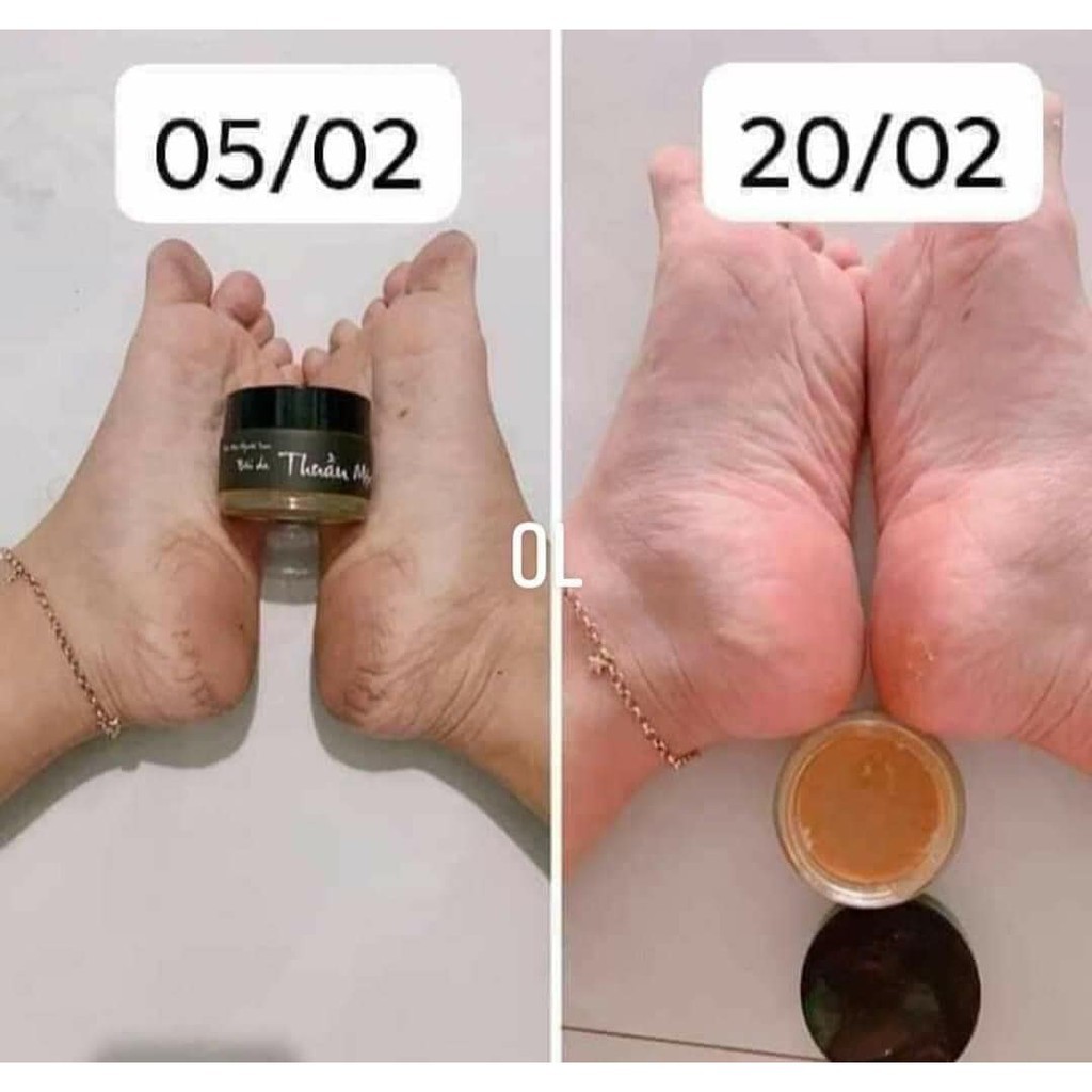 [Chính Hãng] Bôi da - Cao bôi khô da nhiệt miệng | BigBuy360 - bigbuy360.vn