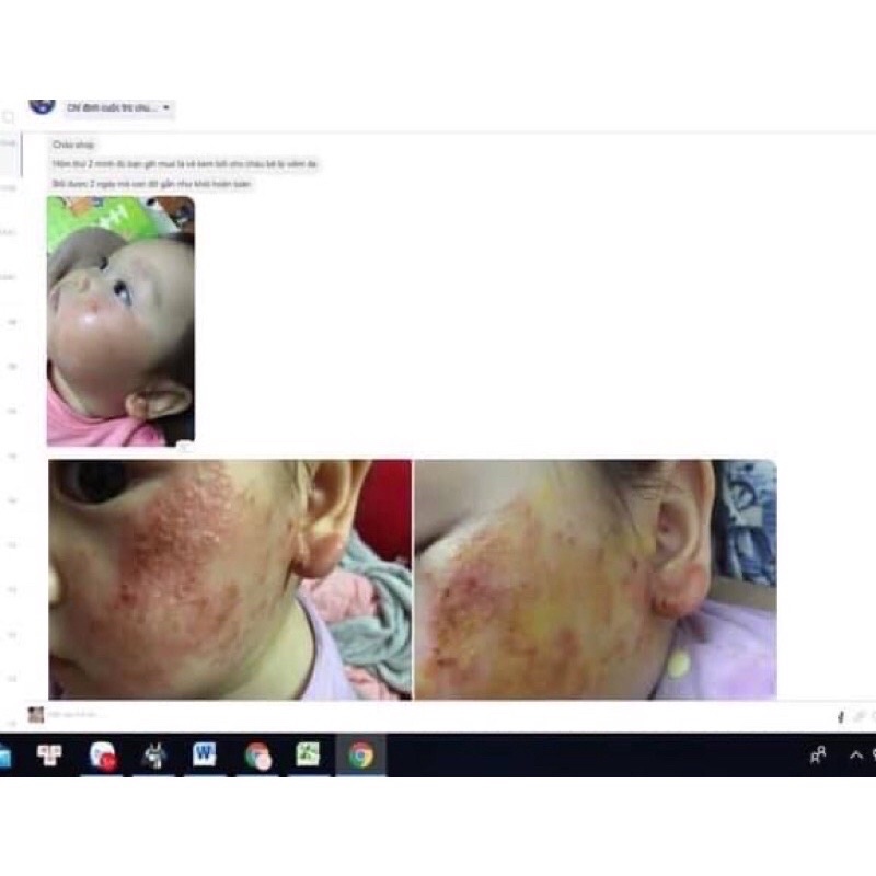 Kem bôi hoàng minh đường(hết chàm,hăm,rôm cho bé 0 tháng tuổi)