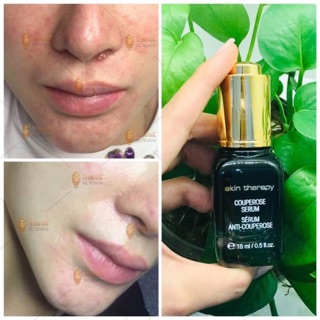 Tinh Chất Thanh Lọc Da Đa Tầng Skin Therapy Couperose Serum
