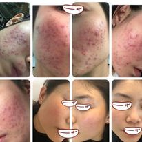 Serum Loại Bỏ Mụn Detox Blanc