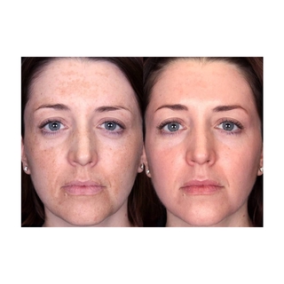 Kem A313 Pommade Retinol Cream