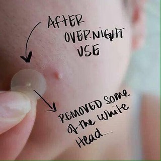 [ Chính Hãng ] Miếng Dán Mụn Cấp Tốc Cosrx Acne Pimple Master Patch