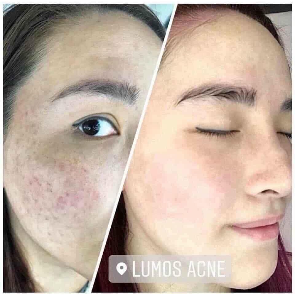 Serum mụn Lumos Ance, sạch mụn mờ thâm, dưỡng da trắng sáng mịn màng