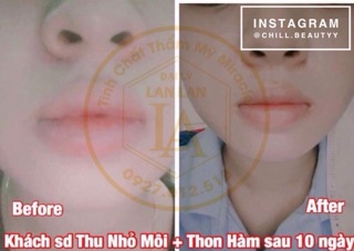 Tinh chất thu nhỏ môi