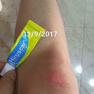 Kem mờ sẹo hiruscar thái