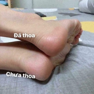 Kem TRỊ NỨT GÓT CHÂN