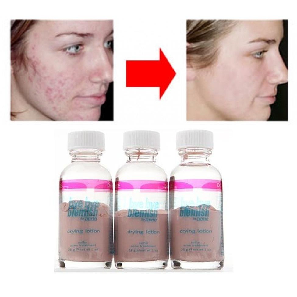 Kem Bye Bye Blemish Làm Sạch Mụn