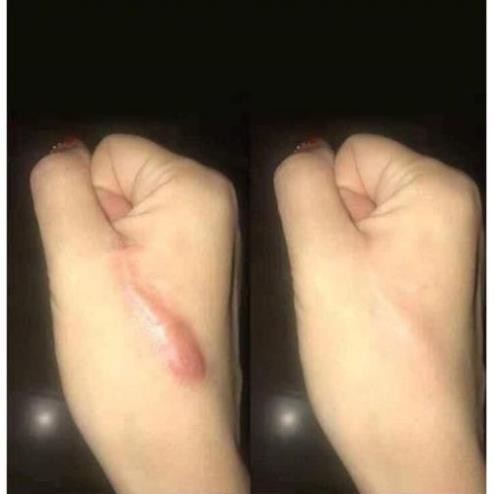 Kem mờ sẹo Nga [CHÍNH HÃNG 100%] - Tuýp 25g - Mờ các loại sẹo, rạn, thâm, nám hãy kiên trì sau 2 tháng để thấy hiệu quả | BigBuy360 - bigbuy360.vn