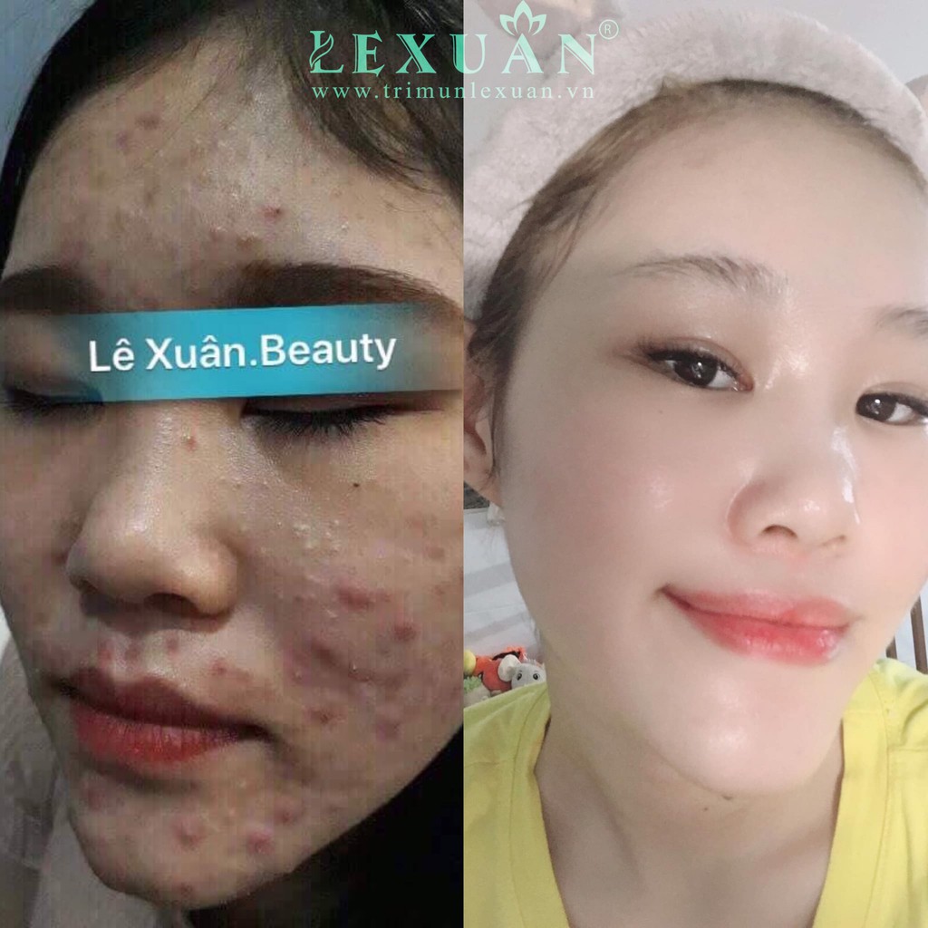 Sạch Mụn Thâm Lê Xuân Cosmetic 130ml Sạch Mụn Trứng Cá Mụn Ẩn Mụn Đầu Đen Tinh chất ngừa mụn Lê Xuân hiệu quả sau 2 tuần