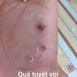 Gel tẩy nốt ruồi Nga