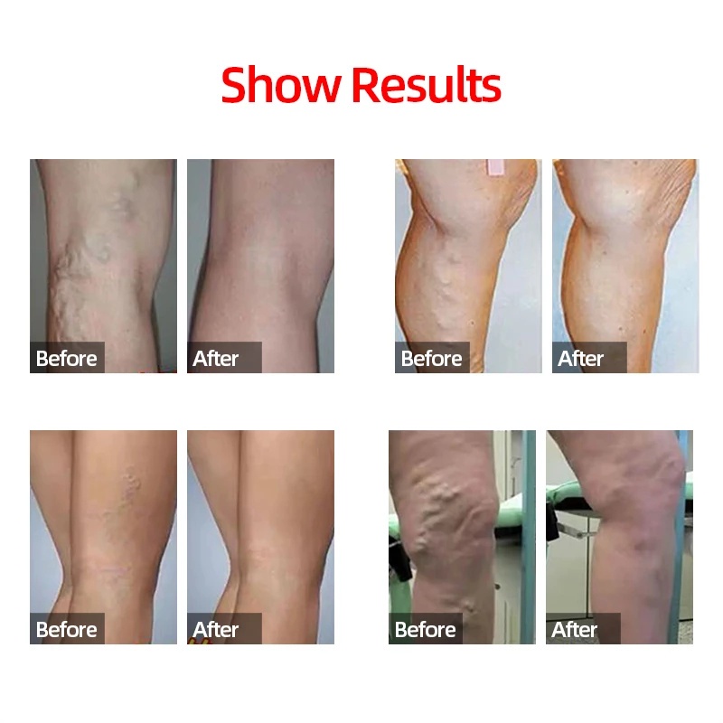 1 Đôi Vớ Nén Bắp Chân Cotton Mềm Mại Thoáng Khí Ngăn Ngừa Giãn Tĩnh Mạch / Giảm Đau Bắp Chân Thể Thao Dành Cho Nam Và Nữ