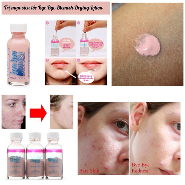 Dung Dịch Chấm Xẹp Mụn Sưng Cấp Tốc Bye Bye Blemish Drying Lotion