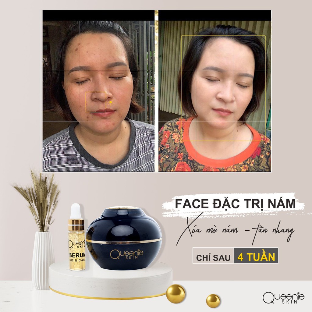 COMBO 2 Hộp Kem Nám, Tàn Nhang QUEENIE SKIN 30 Gram - HÀNG CHÍNH HÃNG