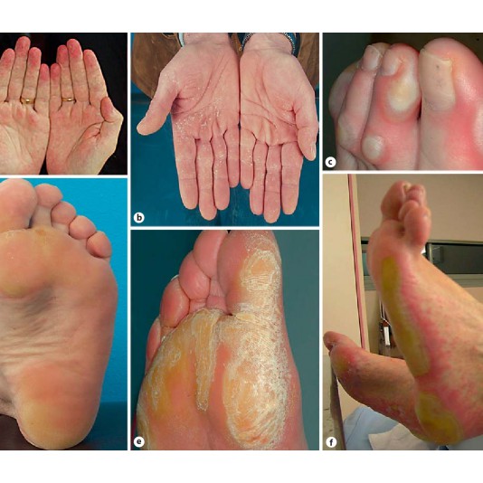 RECONVAL B6 - Hỗ trợ làm giảm hội chứng bàn tay bàn chân do tác dụng phụ của chữa tr ị ung thư