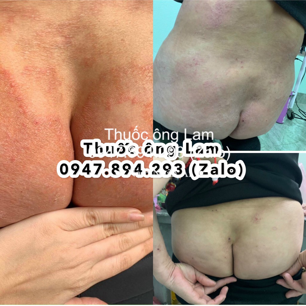 Hắc lào, nấm bẹn dứt điểm Đông Y gia truyền Ông Lam | BigBuy360 - bigbuy360.vn