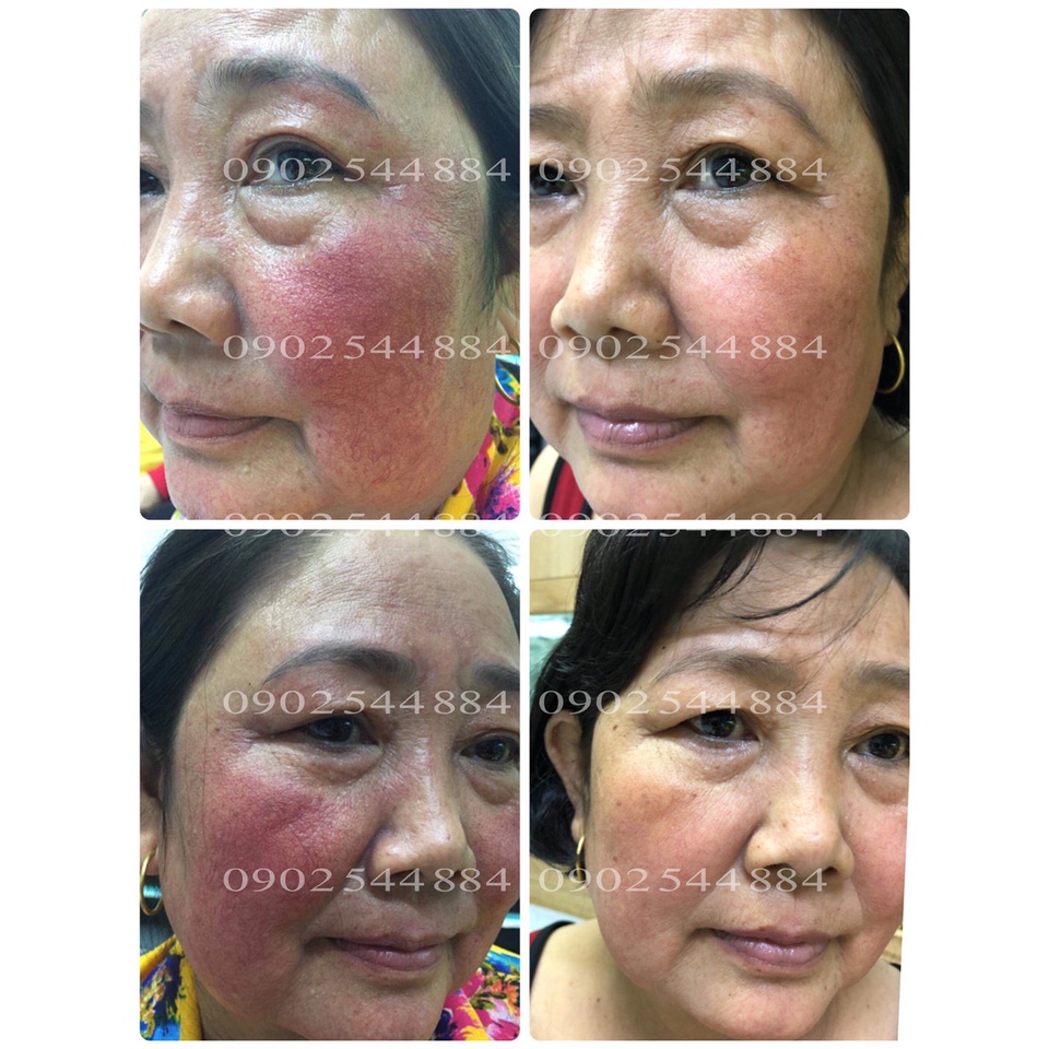 Serum nám Hoàng Trinh