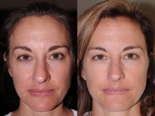 SERUM THE ORDINARY - RETINOL 1% IN SQUALANE