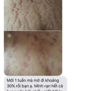 DẦU TRỊ RẠN