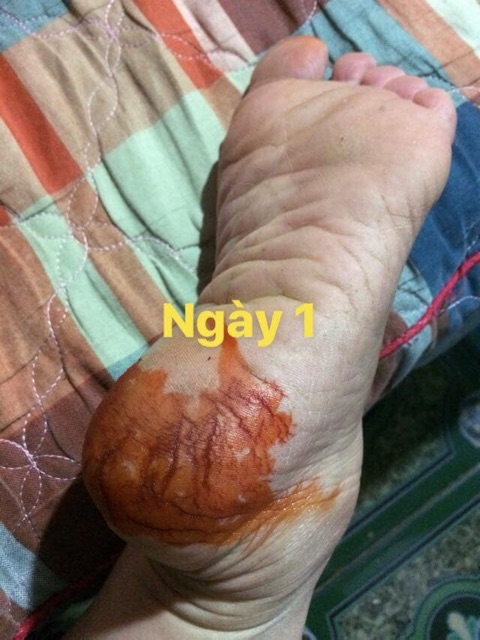 Bôi Nứt Gót Chân kiểu gì cũng hết nứt | BigBuy360 - bigbuy360.vn