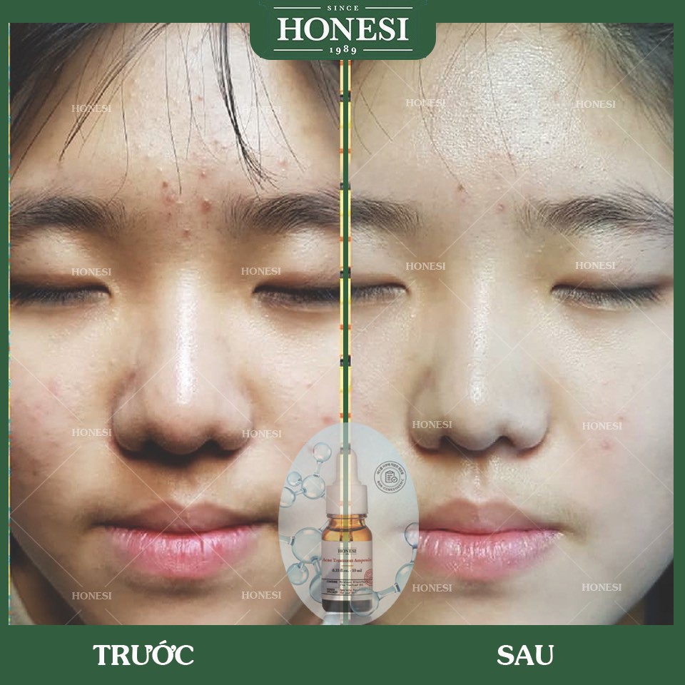Sét Serum Giảm Mụn Nhanh Lành Tính HONESI Acne Treatment Ampoule (10ml x 5 lọ) - Hàn Quốc BONGSHOPAUTHENTIC | BigBuy360 - bigbuy360.vn