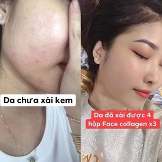 Combo Kem Collagen X3 Đông Anh