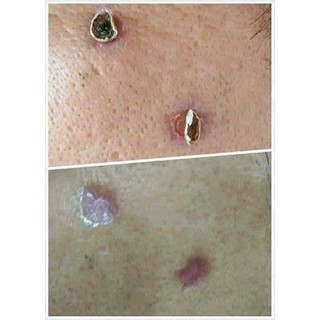 TẨY NỐT RUỒI, MỤN CƠM, MỤN CÓC, THỊT THỪA
