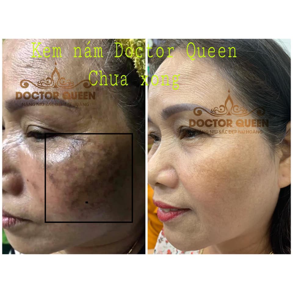 KEM NÁM DOCTOR QUEEN --