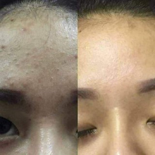 Tế bào gốc mụn DNA cá hồi KBA