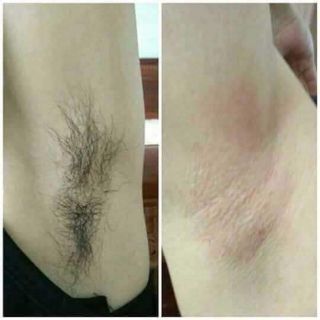 Combo triệt lông vĩnh viễn
