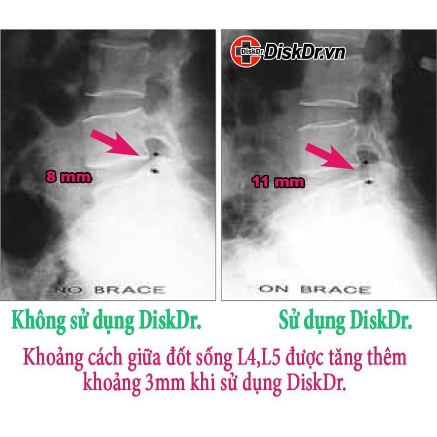 Đai kéo giãn cột sống lưng Disk Dr WG-30 G2 và WG-50  phiên bản mới