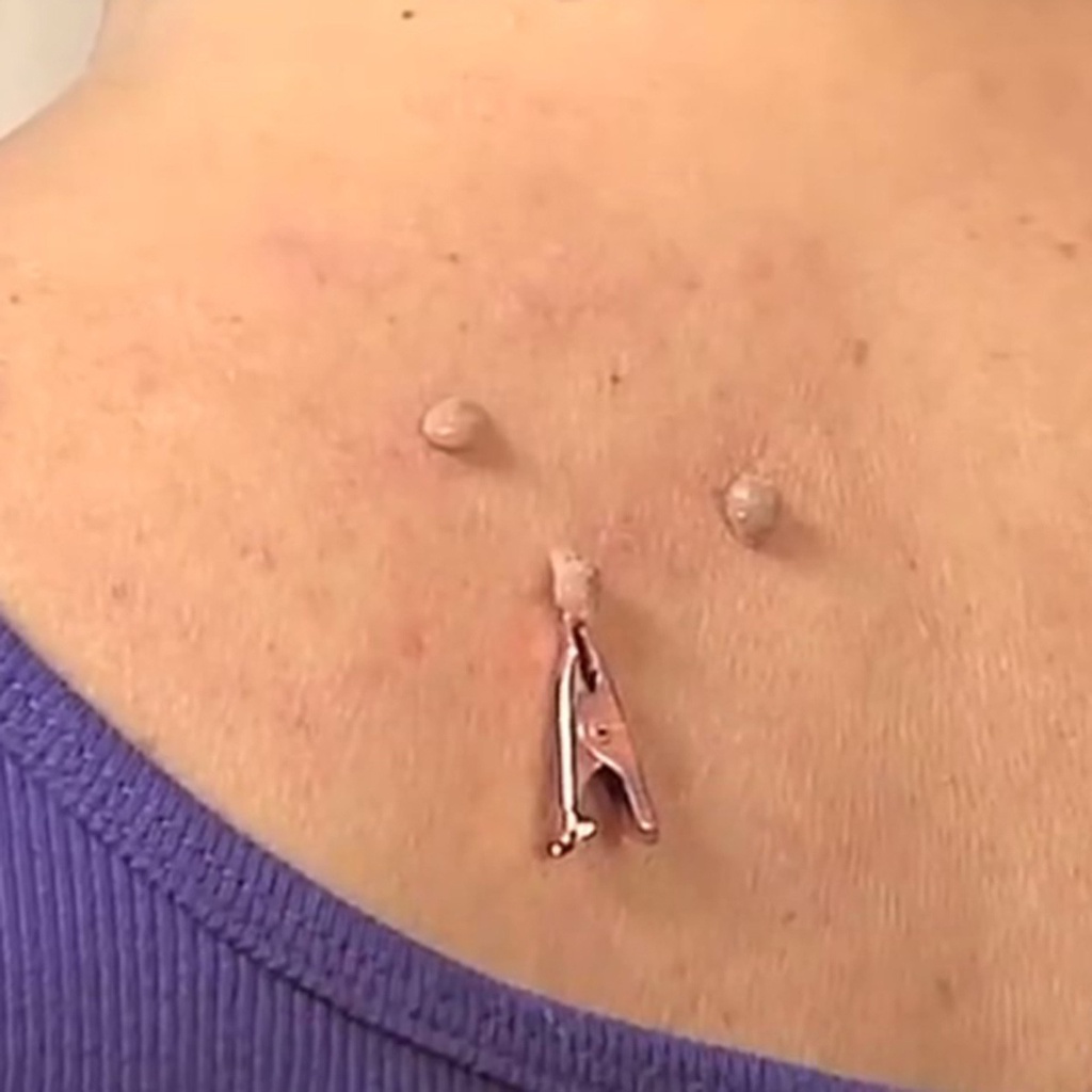 Dụng Cụ Hỗ Trợ Giảm Mụn Đầu Đen / Hình Xăm Dạng Kẹp Tiện Dụng