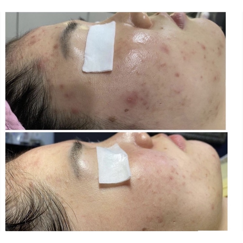Ampoule Mụn Daylisse Dermaclean AC Chocho Ampoule | BigBuy360 - bigbuy360.vn