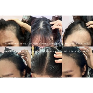 Xịt mọc tóc Minoxidil 5% nội địa Pháp