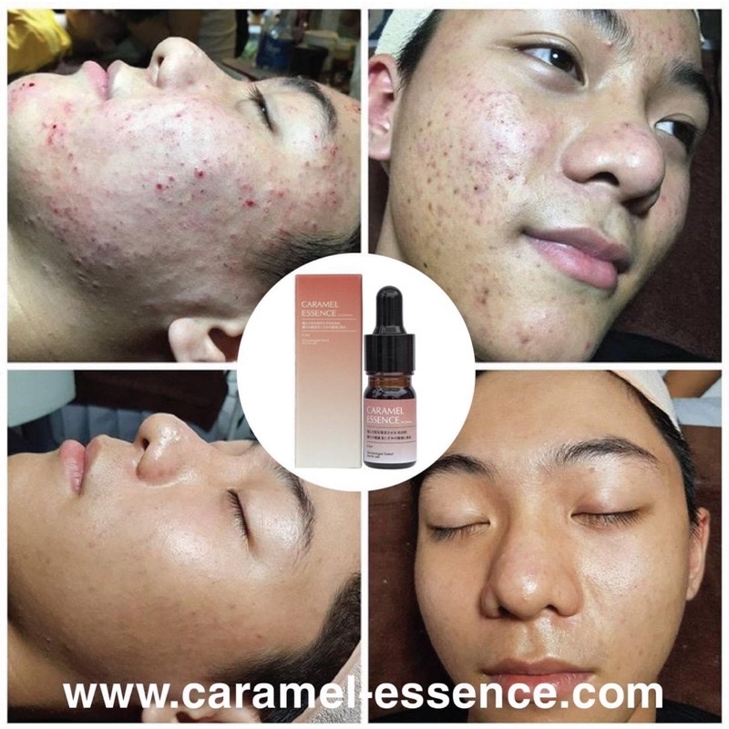 Serum CARAMEL ESENCE Ngừa Mụn Xoá Thâm Hãng Nhật Bản{Mua 1 sản phẩm được tặng quà} | BigBuy360 - bigbuy360.vn