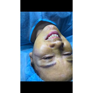 Chỉ xoá nhăn mắt