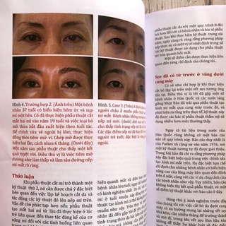 Tài Liệu Tham Khảo (Treo Cung Mày )