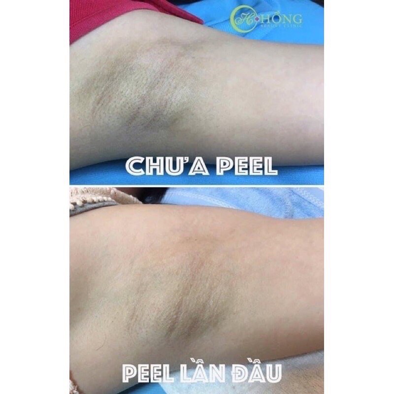 Peel hồng ti,nách, bikini TCA USA | BigBuy360 - bigbuy360.vn