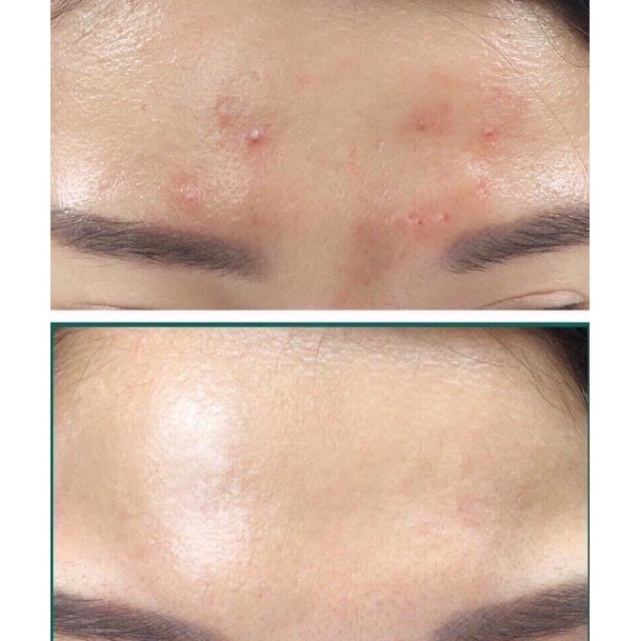 Kem dưỡng ngăn ngừa mụn và dưỡng trắng Kracie Hadabisei Acne