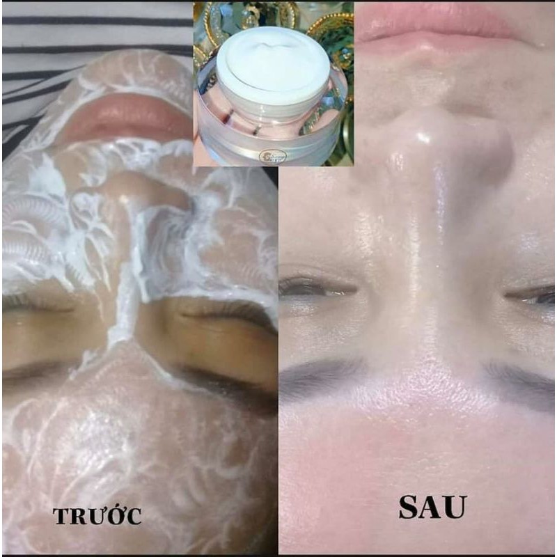 COMBO CẤY TRẮNG LỤA + MÁY DI TINH CHẤT - SPA TẠI NHÀ