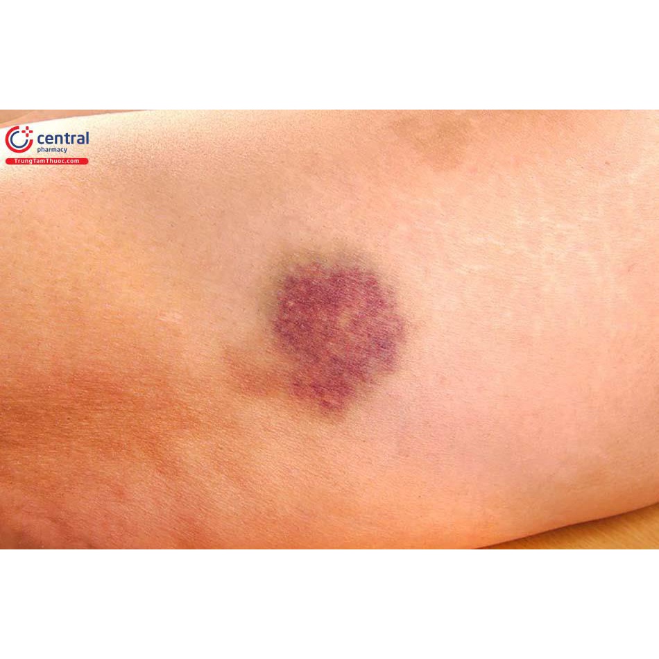 Kem bôi tan bầm tím Arnigel 45g hàng nội địa Pháp