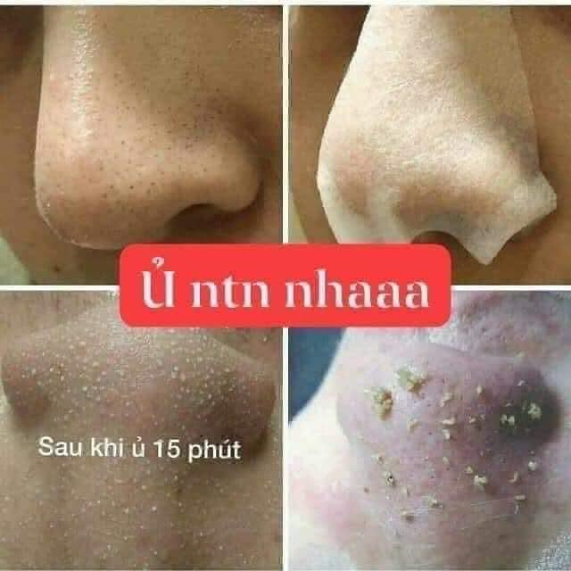 Ủ mụn đầu đen Medi-peel Blackhead care solution extra super 9+ mẫu mới hàng chính hãng