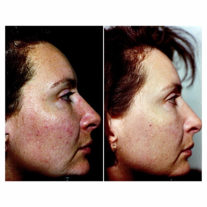 Khăn tẩy da chết SOMME INSTITUTE TRANSPORT Exfoliating Glycolic Acid fullsize 50 miếng