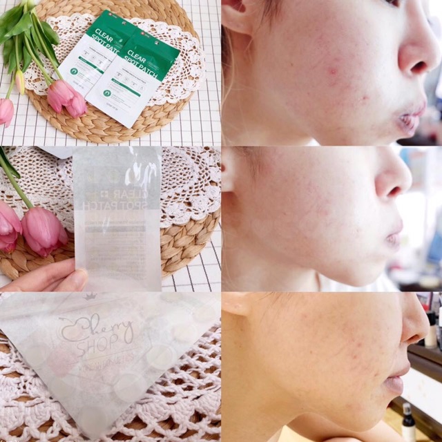 💥🍒Miếng Dán Mụn Some By Mi Clear Spot Patch