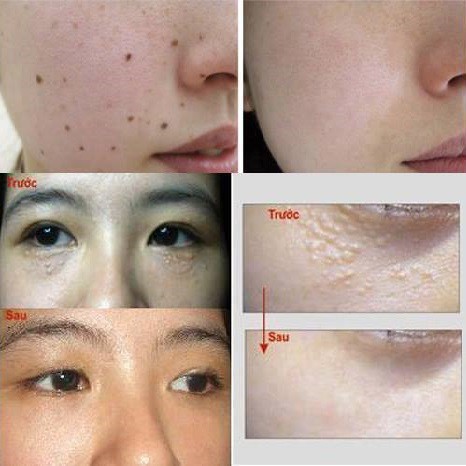 Gel tẩy nốt ruồi mụn cóc mụn thịt mụn cơm mụn ruồi Nga