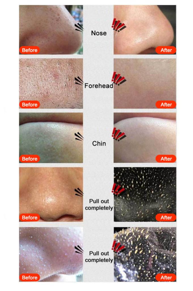 Mặt nạ bùn khoáng lột mụn đầu đen lỗ chân lông làm sạch da | BigBuy360 - bigbuy360.vn