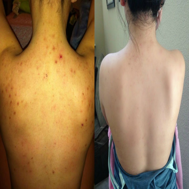 Sữa Tắm hết mụn lưng 💝 FREESHIP💝 Sữa Tắm Than Tre Thái Lan trắng da,giảm thâm,ngăn ngừa mụn | BigBuy360 - bigbuy360.vn